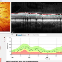 Glaucoma Management & Screenings