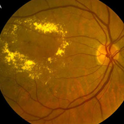 Diabetic Ocular Examinations