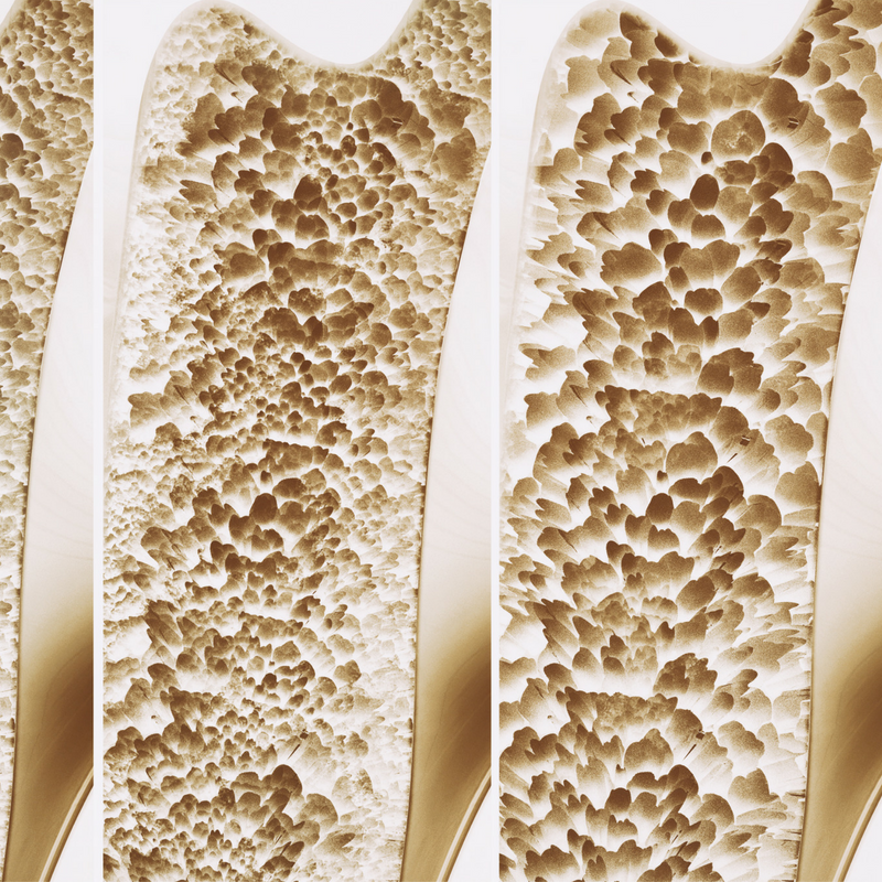 Natural Osteoporosis and Menopause