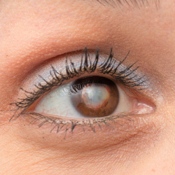 Cataracts