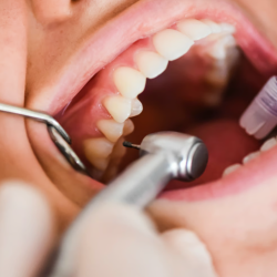 Teeth Cleanings