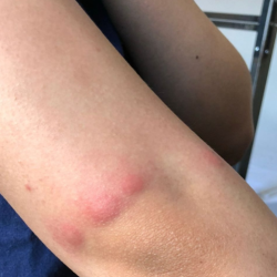 Bed Bug Treatment
