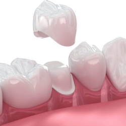 Dental Crown
