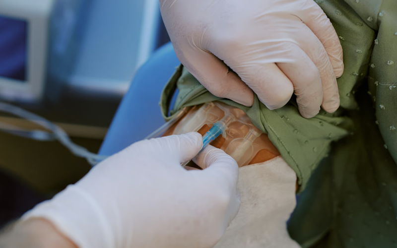 Stent Placement