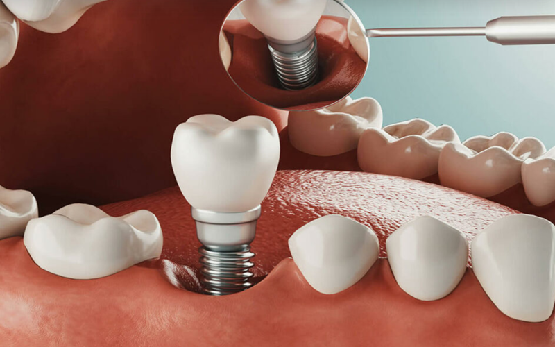 Dental Implants