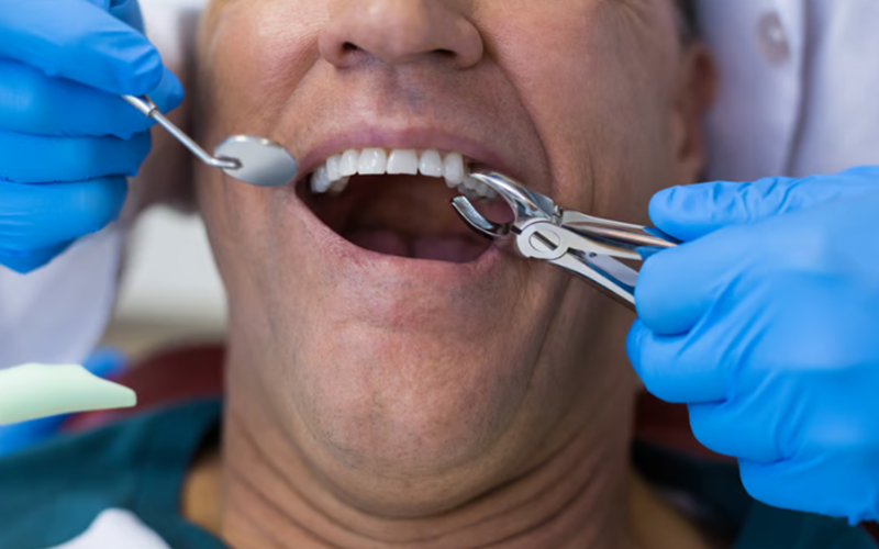 Tooth Extractions