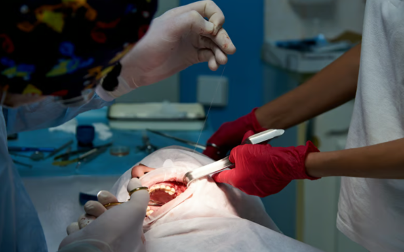Wisdom Teeth Removal