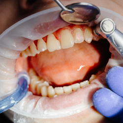 Treatment of Gum Diseases