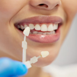 Teeth Whitening