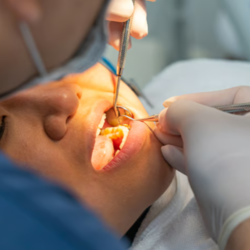 Wisdom Tooth Removal
