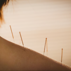 Traditional Japanese Acupuncture