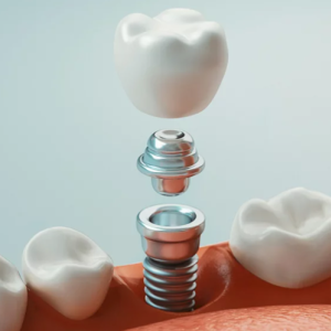 Dental Implants