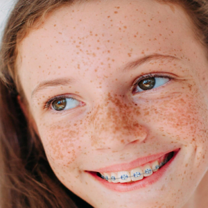 Clear Braces