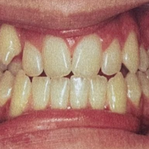 Treatment for Bite Issues (Malocclusion)
