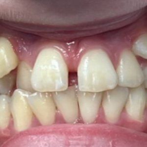 Treatment for Alignment Issues