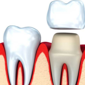 Same Day Crowns