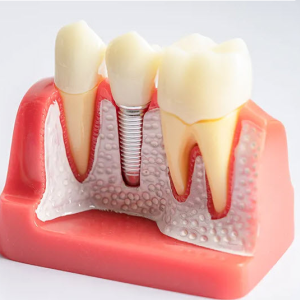 Implant Dentistry