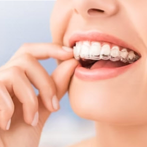 Invisalign