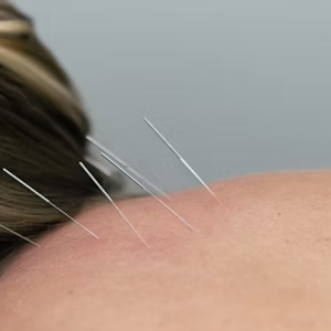 Acupuncture