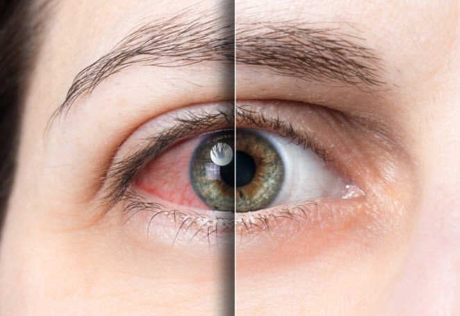  Eye Emergencies 