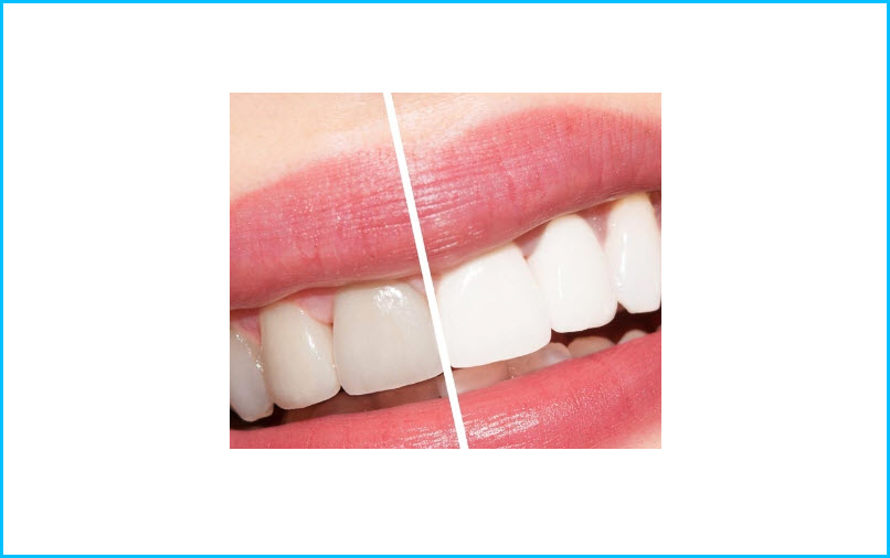 Timely Whitening Services