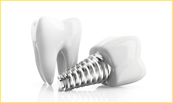 Dental implants