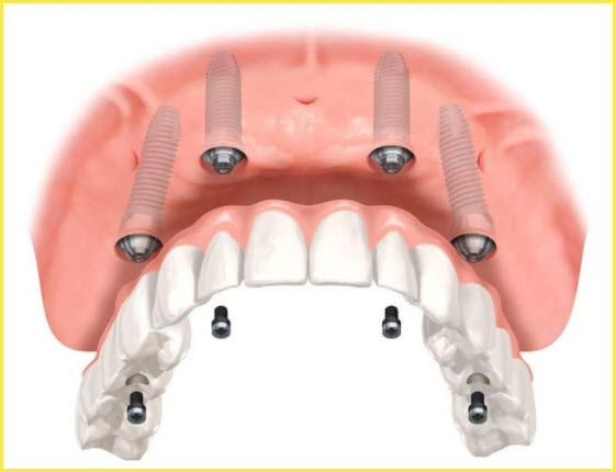 Nobel Biocare All-on-4