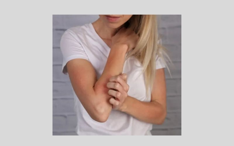 Eczema