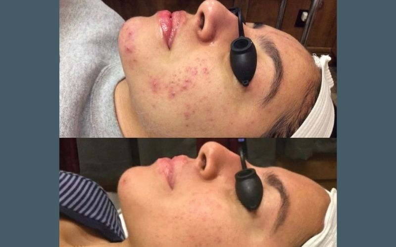 Facials