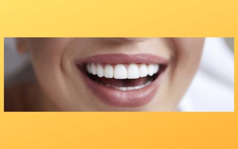 Teeth Whitening