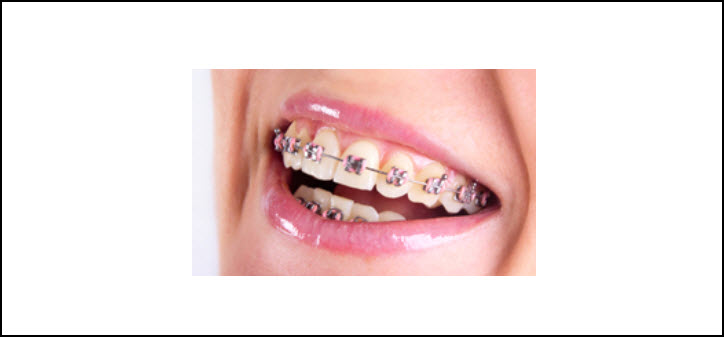 Traditional Metal Braces