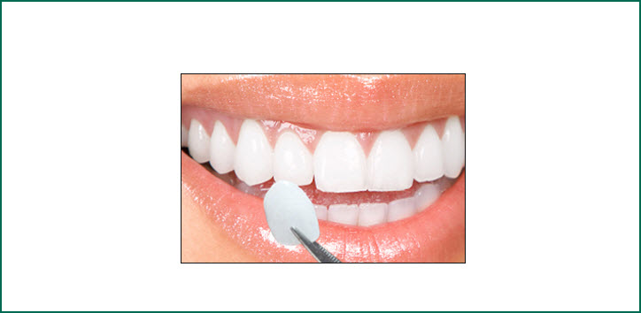Veneers