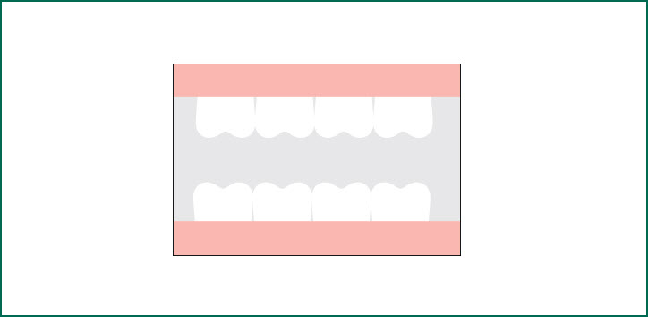 Dentures