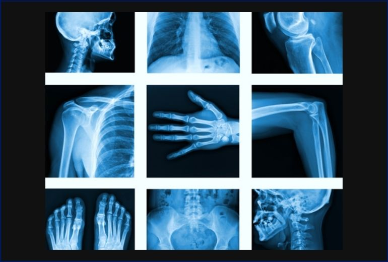 X-Ray