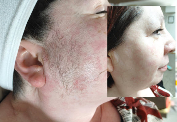 Dermaplaning