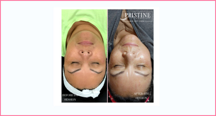 Microneedling