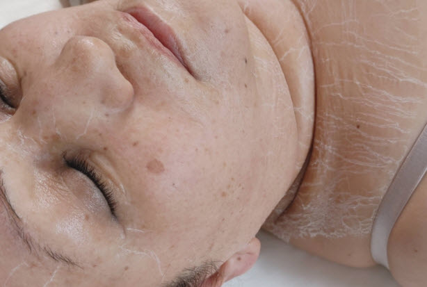 Protein Lift Oxygen Therapy