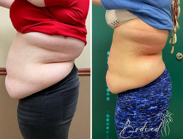Ultrasonic Cavitation