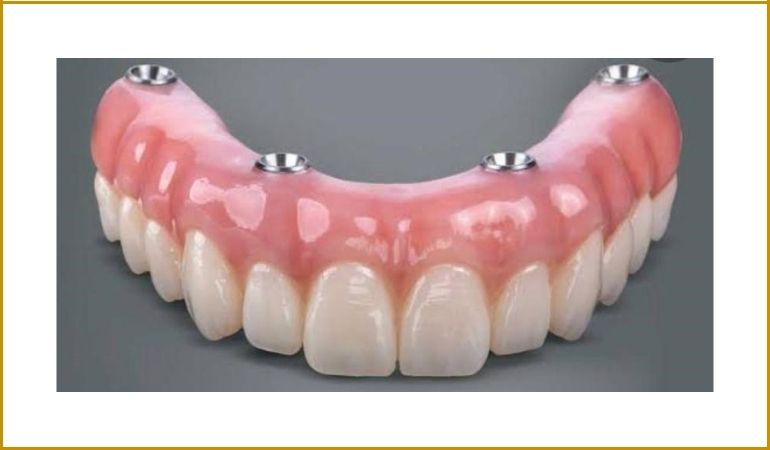 Fixed Implant Dentures