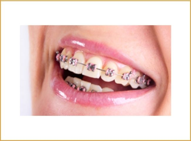 Traditional Metal  Braces