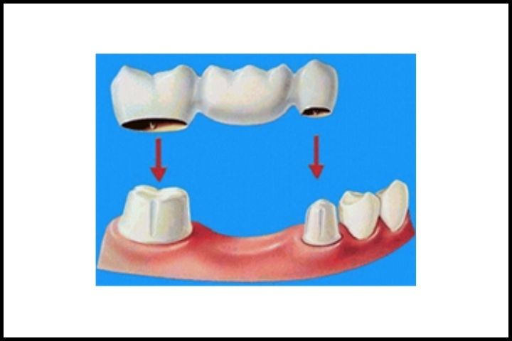 Bridge Restorations