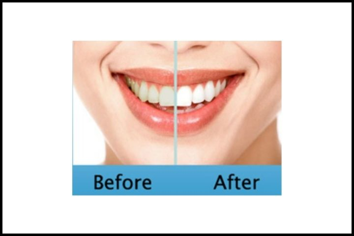 Tooth Whitening