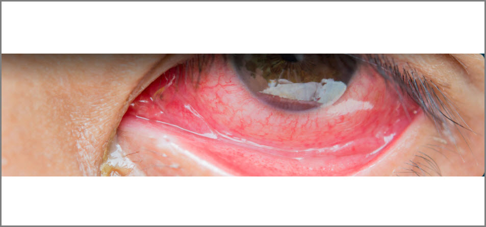 Common Eye Conditions