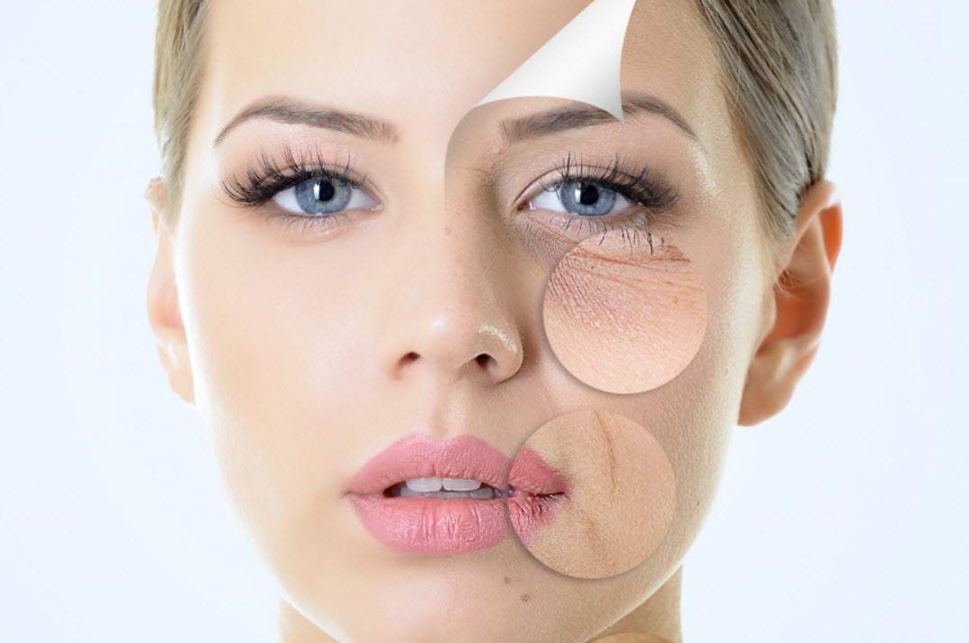  Microneedling