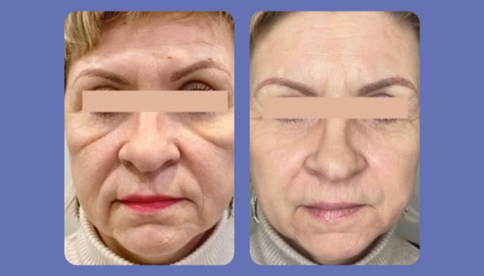 Non-Surgical Face Lift