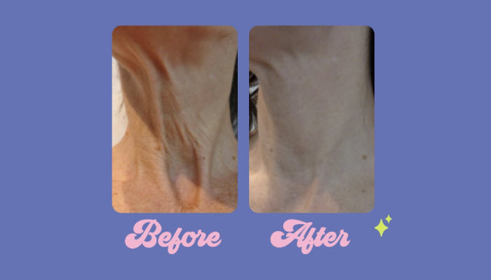 Wrinkle Rehab Microneedling