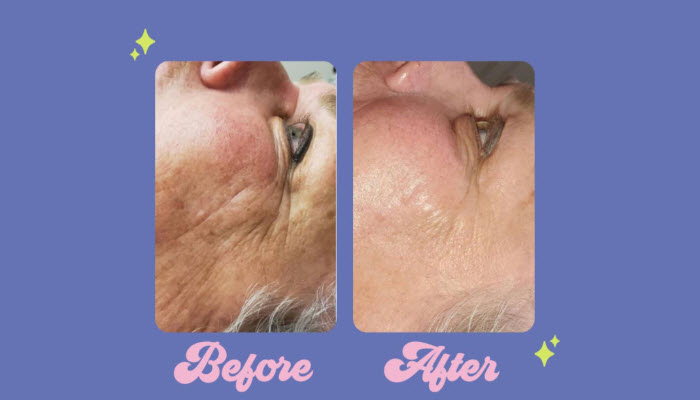 Gentle Enzymatic Exfoliation