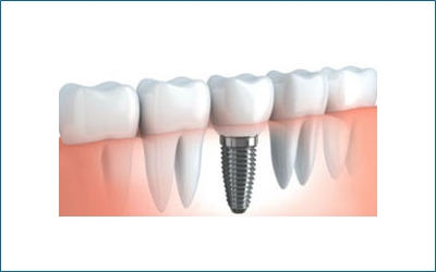 Implant Dentistry