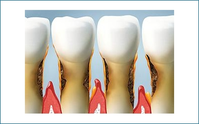 Gum Treatment