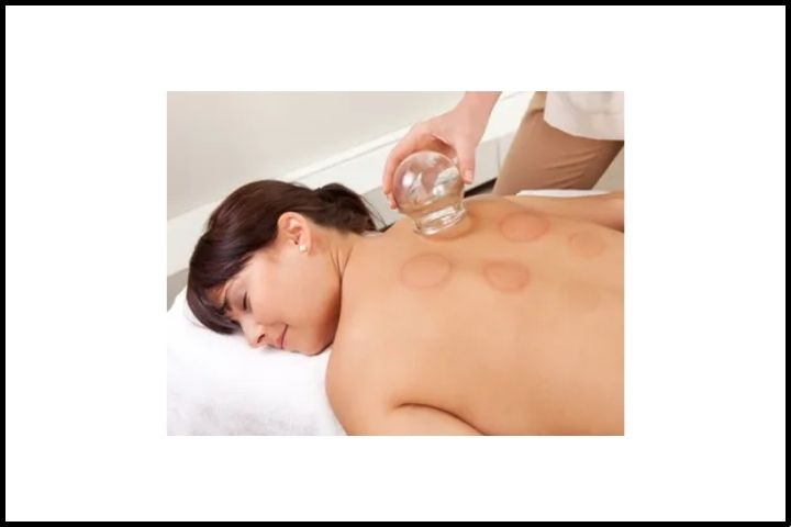 Cupping Therapy